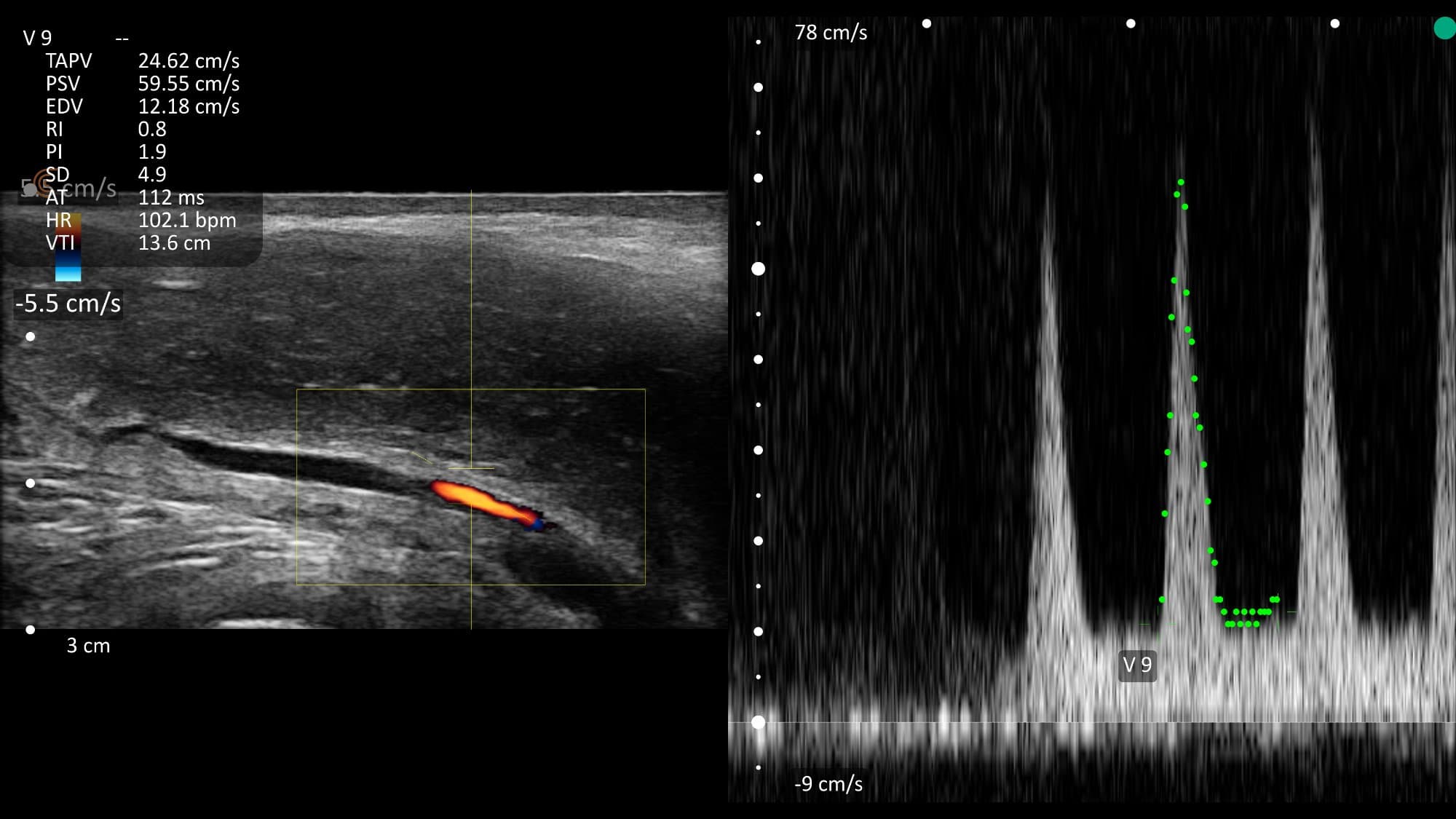 Penile Doppler waveform - elevated EDV with high heart rate (false venous leak pattern)
