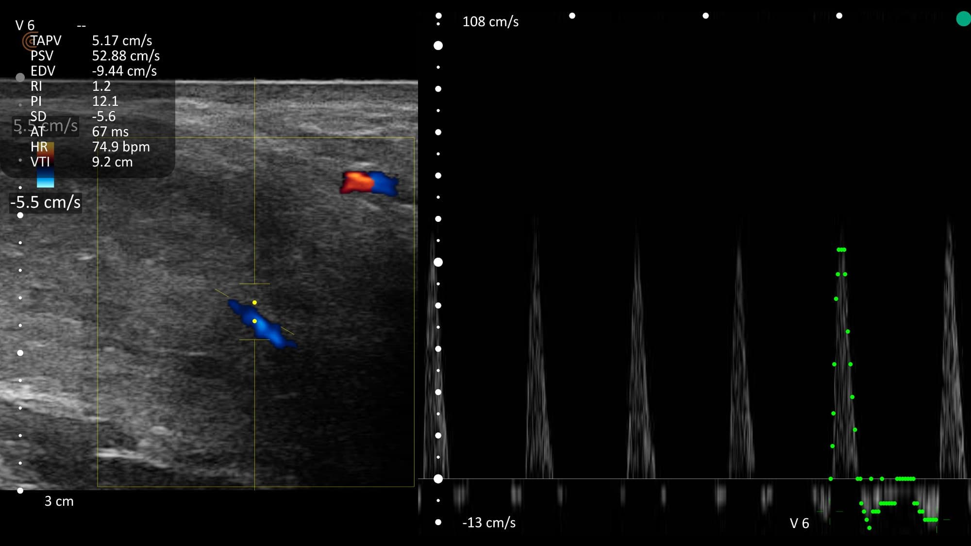 Penile Doppler waveform - reversed diastolic flow after phentolamine (venous leak resolved)