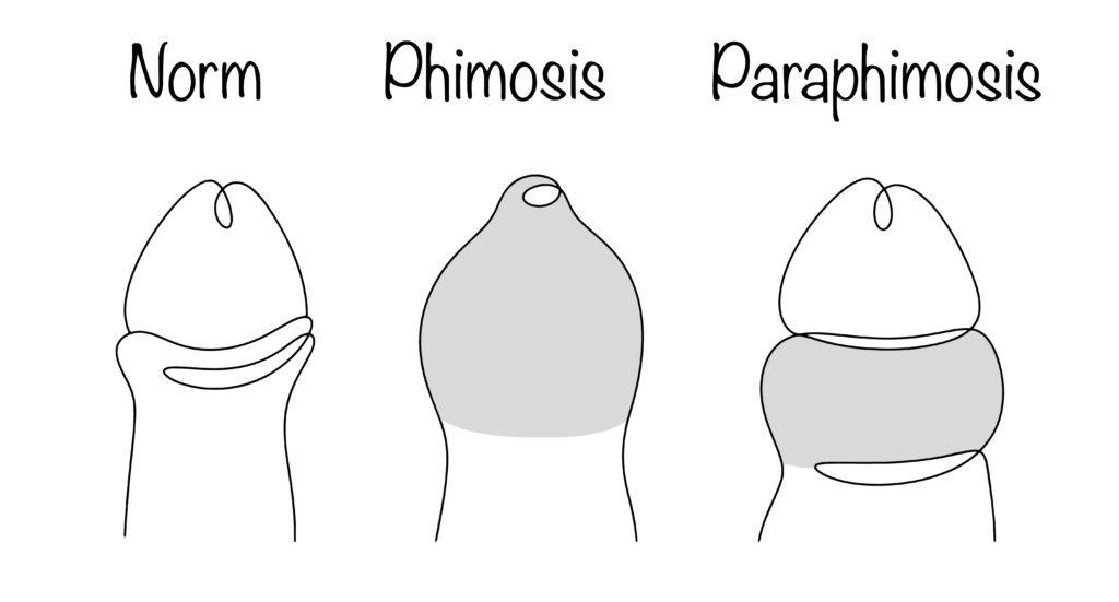 Diagram comparing normal foreskin, phimosis, and paraphimosis conditions.