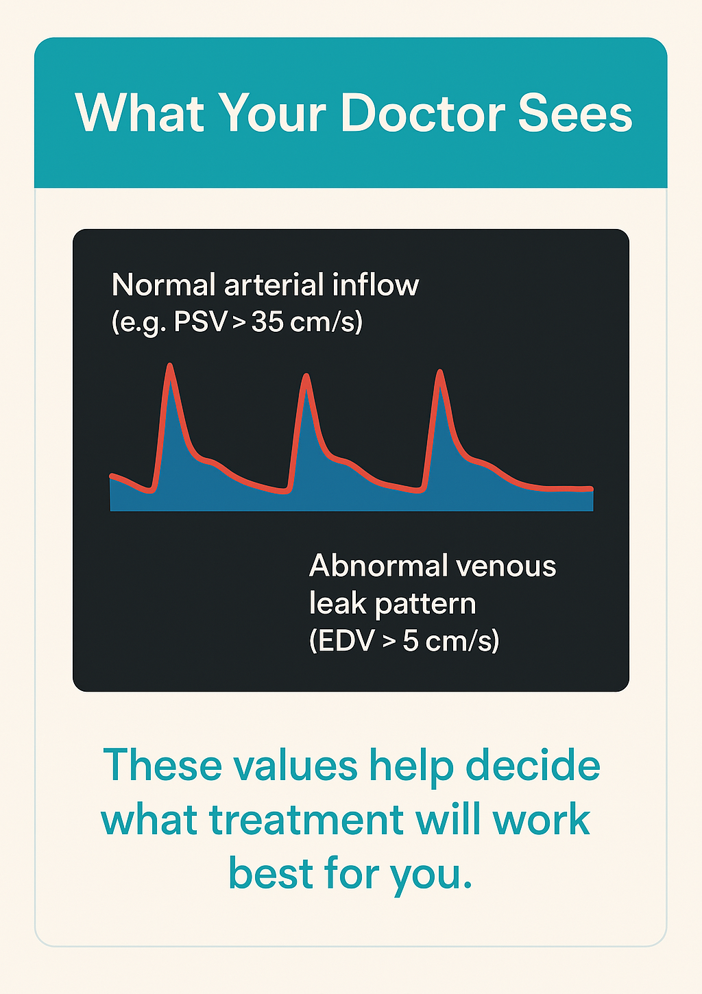 Stylised Doppler waveform showing normal arterial inflow and abnormal venous leak pattern.